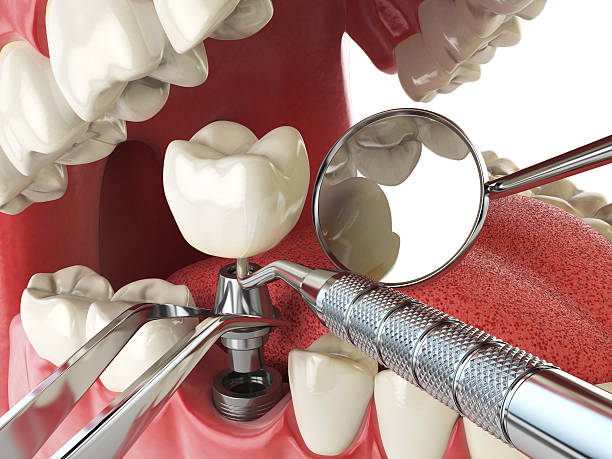 Best Emergency Treatment for Toothache in Fountain Inn, SC